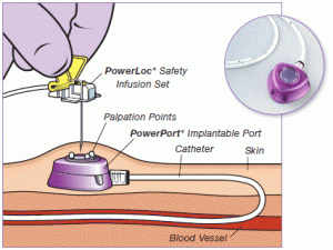 Fonte: http://cirurgia.med.br/2012/01/cateter-para-quimioterapia/
